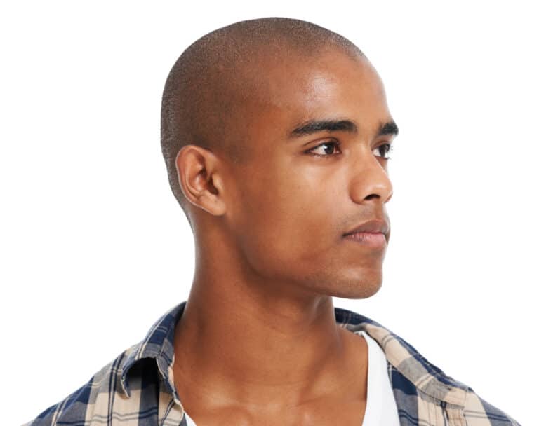 Tricopigmentation implants capillaires perte de cheveux Gieres Grenoble